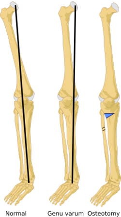 Osteotomy tibia en.svg