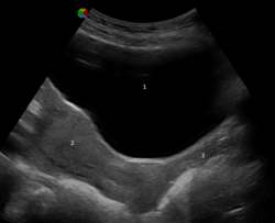Ultrasonograph depicting urinary bladder at the top, above the uterus to its bottom-left and vagina to its bottom-right