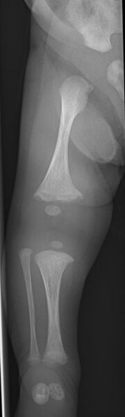 File:X-ray of osteogenesis imperfecta type 5 in newborn - right leg.jpg