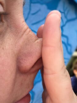 An image of the nose being pressed upwards by the fingers or palm to relieve nasal irritation caused by allergies, known as the allergic salute sign.
