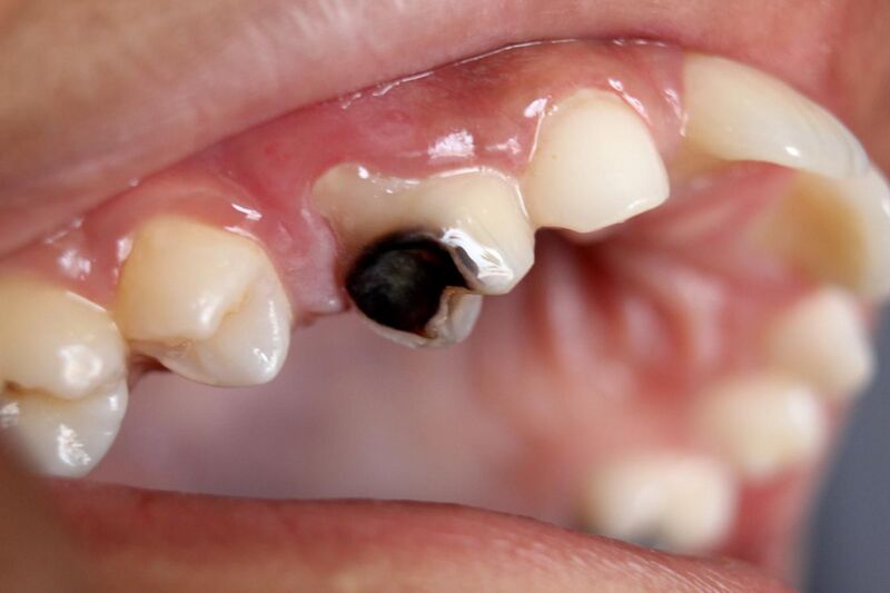File:Dental Caries Cavity 2.JPG