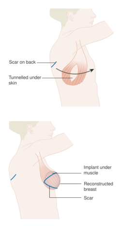 Diagram showing breast reconstruction using the latissimus dorsi muscle and an implant CRUK 405.svg
