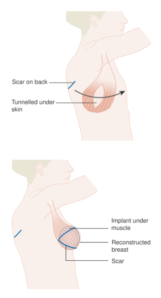 File:Diagram showing breast reconstruction using the latissimus dorsi muscle and an implant CRUK 405.svg
