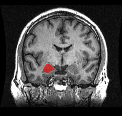 MRI coronal view of the amygdala