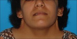Preoperative webbed neck in Turner syndrome.jpg