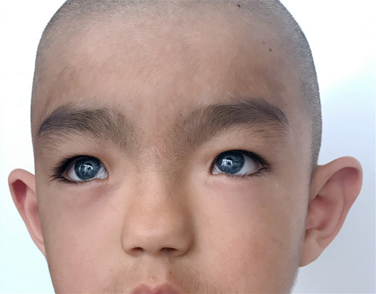 File:Waardenburg syndrome type 1.png