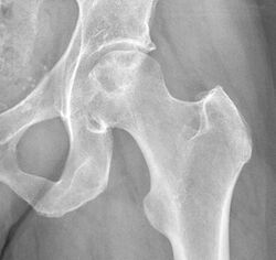 X-ray of idiopathic avascular necrosis of the femoral head - Anteroposterior.jpg