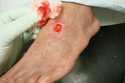 Arterial ulcer peripheral vascular disease.jpg