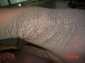 Familial acanthosis nigricans4.jpg