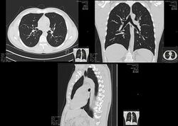 High-resolution computed tomographs of a normal thorax (thumbnail).jpg