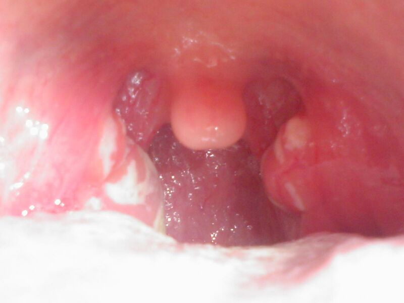 File:Streptococcal pharyngitis 1.jpg