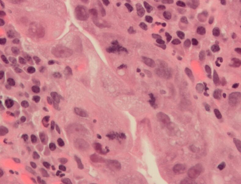 File:Atypical mitosis.jpg