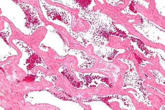 Cavernous liver hemangioma - intermed mag.jpg