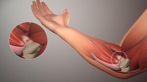 A 3D medical animation still shot illustrating Golfer's elbow
