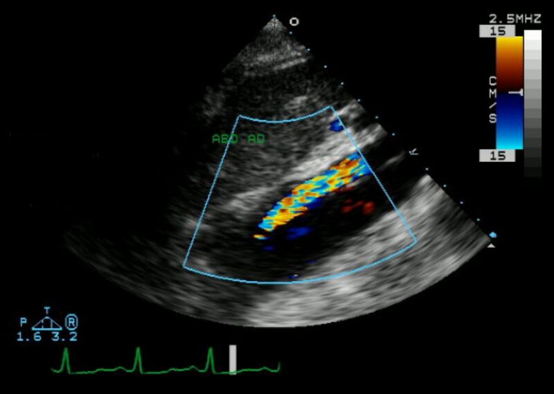 File:Aortic dissection - Echocardiogram - Longitudinal view - Color.jpg