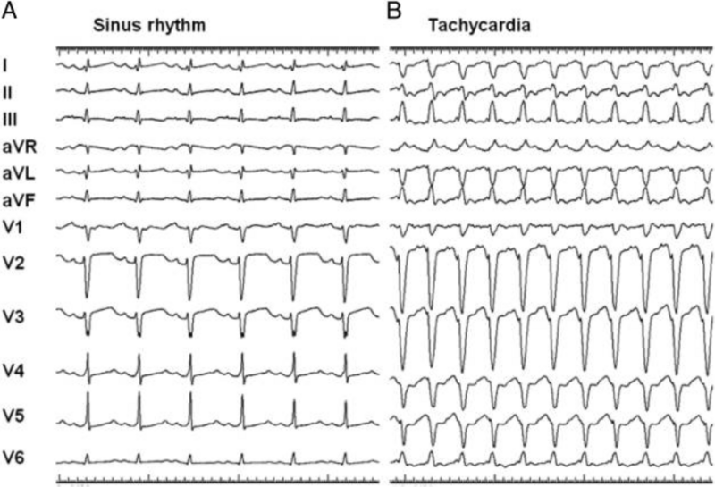 File:ECGs in Ebstein's anomoly with Mahaim accessory pathway.png