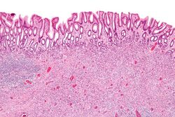 Inflammatory fibroid polyp - low mag.jpg