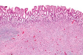 Inflammatory fibroid polyp - low mag.jpg