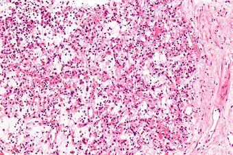 Inflammatory myofibroblastic tumour - high mag.jpg