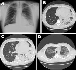 Severe Pneumonia Caused by Legionella pneumophila Serogroup 11, Italy.jpg