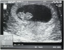 Ultrasound of human fetus, 8 weeks and 1 day.jpg