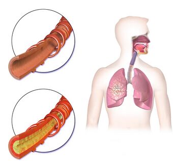 Bronchitis Normal vs Affected Airway.jpg