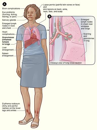 Sarcoidosis signs and symptoms.jpg