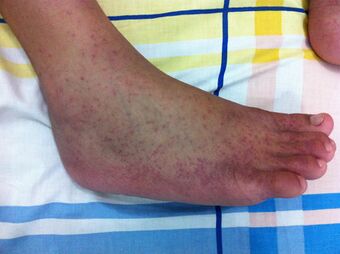 2012-01-09 Chikungunya on the right feet at The Philippines.jpeg