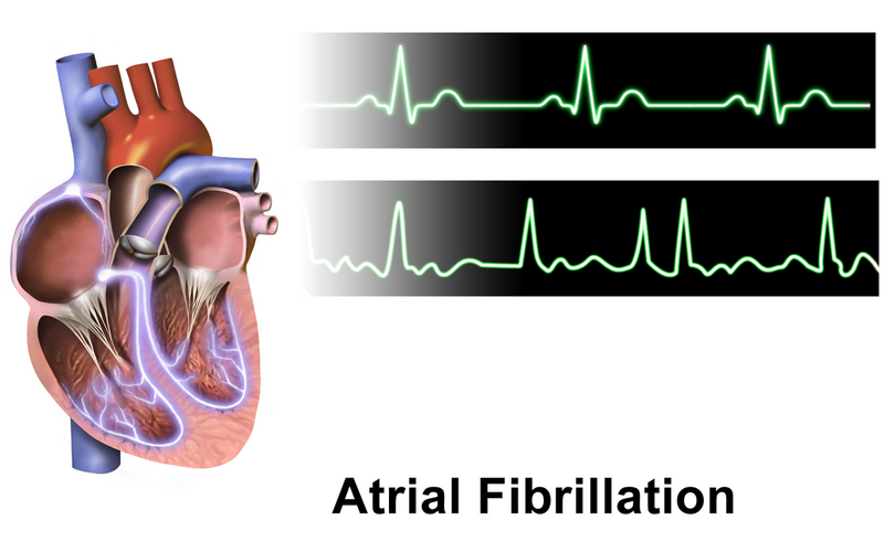 File:Atrial Fibrillation.png