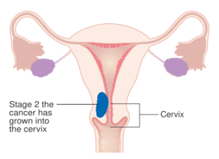 A diagram of stage II endometrial cancer