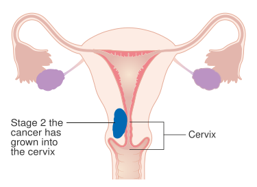 File:Diagram showing stage 2 cancer of the womb CRUK 206.svg
