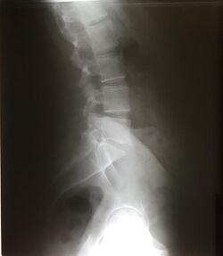 Lateral lumbar x ray.jpg