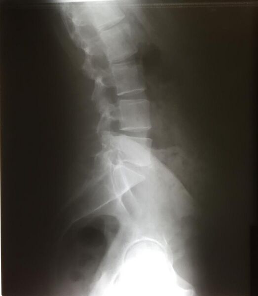 File:Lateral lumbar x ray.jpg