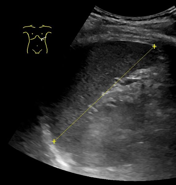 File:Maximum length of spleen on ultrasonography.jpg