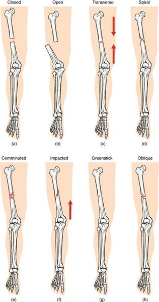 File:612 Types of Fractures.jpg
