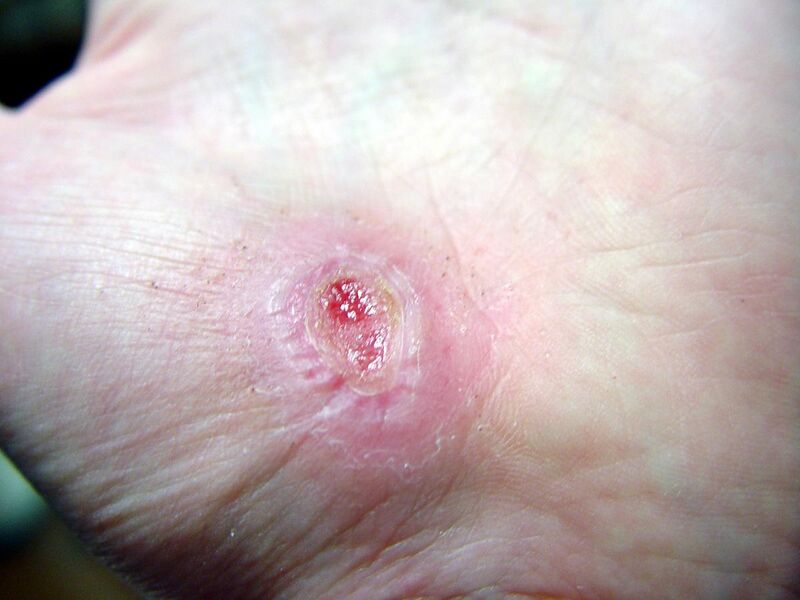 File:Hand Abrasion - 17 days 11 hours 30 minutes after injury.JPG