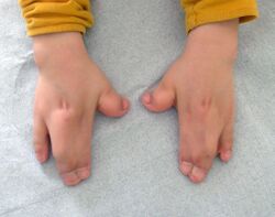 Hands in Apert syndrome.JPG