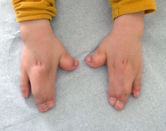 Hands in Apert syndrome.JPG