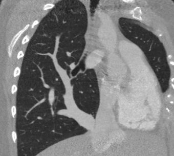 Scimitar syndrome chest CT.jpg