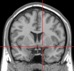 Substantia innominata MRI.PNG