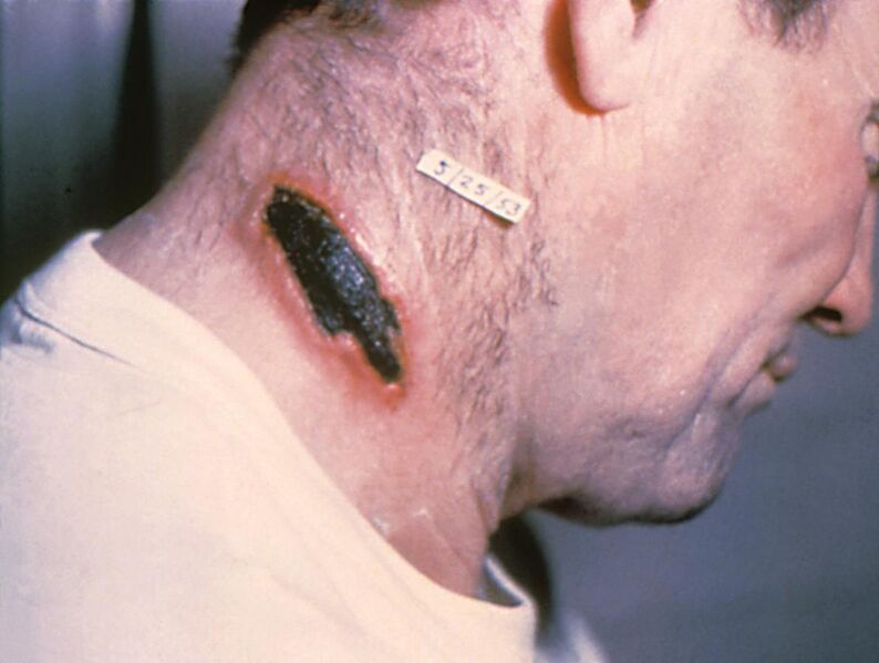 File:Cutaneous anthrax lesion on the neck. PHIL 1934 lores.jpg
