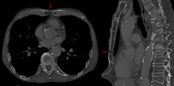 Foramen sternale 85jm - CT axial und sagittal - 001.jpg
