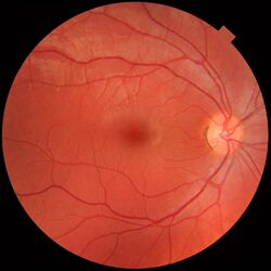 Fundus photograph of normal right eye.jpg