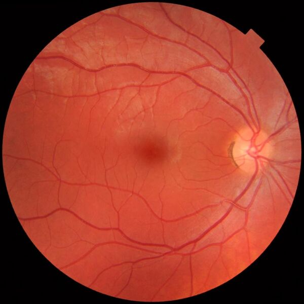 File:Fundus photograph of normal right eye.jpg
