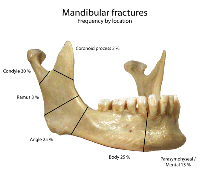 File:Mandbular fractures.png