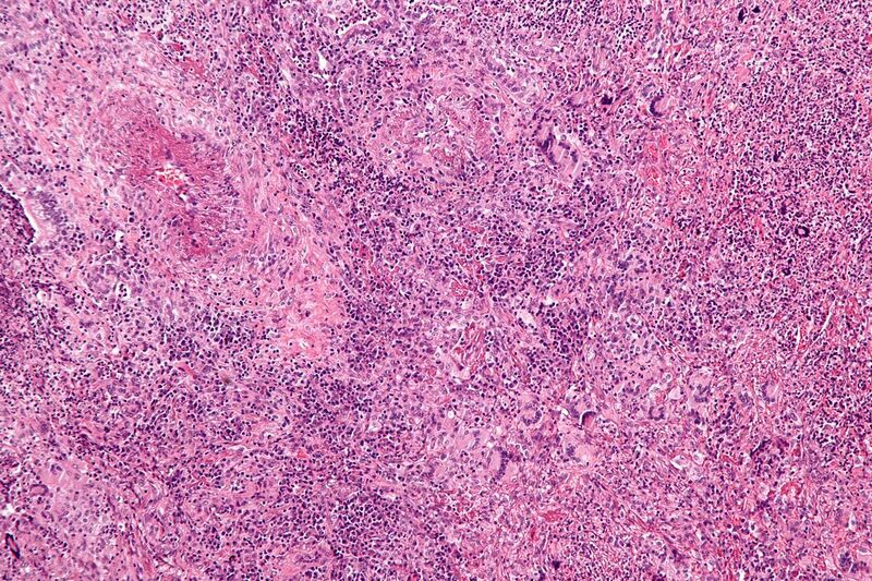 File:Wegener's granulomatosis -b- intermed mag.jpg