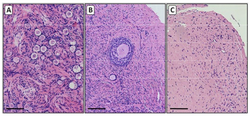 Histological sections of ovarian cortex from patients with TS.png