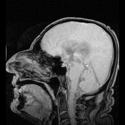 NPH MRI 272 GILD.gif