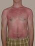 A sunburn is a typical first-degree burn.
