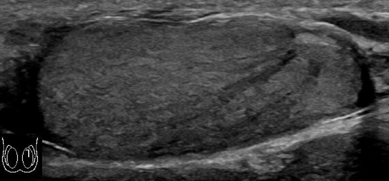 File:Ultrasonography of testicular striations.jpg